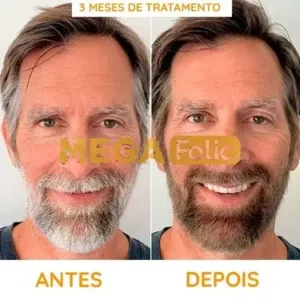 Cabelo branco fica preto com Mega Folic Antes e Depois (Barba)