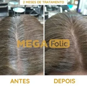 Mega Folic Antes e Depois