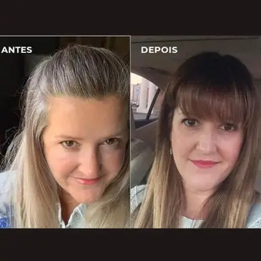 Metilfolato Antes e Depois