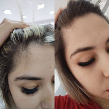 Hairvik tonico antes e depois das falhas