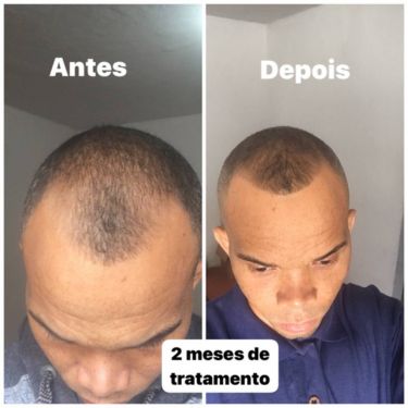 shampoo para crescer o cabelo de homem