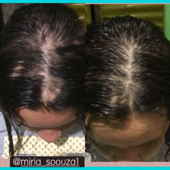 Vitamina Alopecia